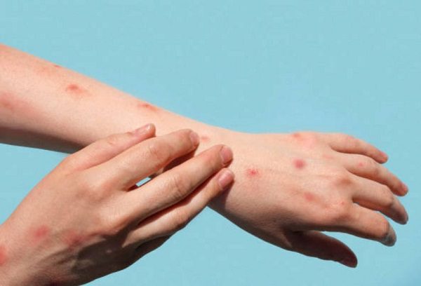 Bulgaria health ministry confirms presence of monkeypox in country